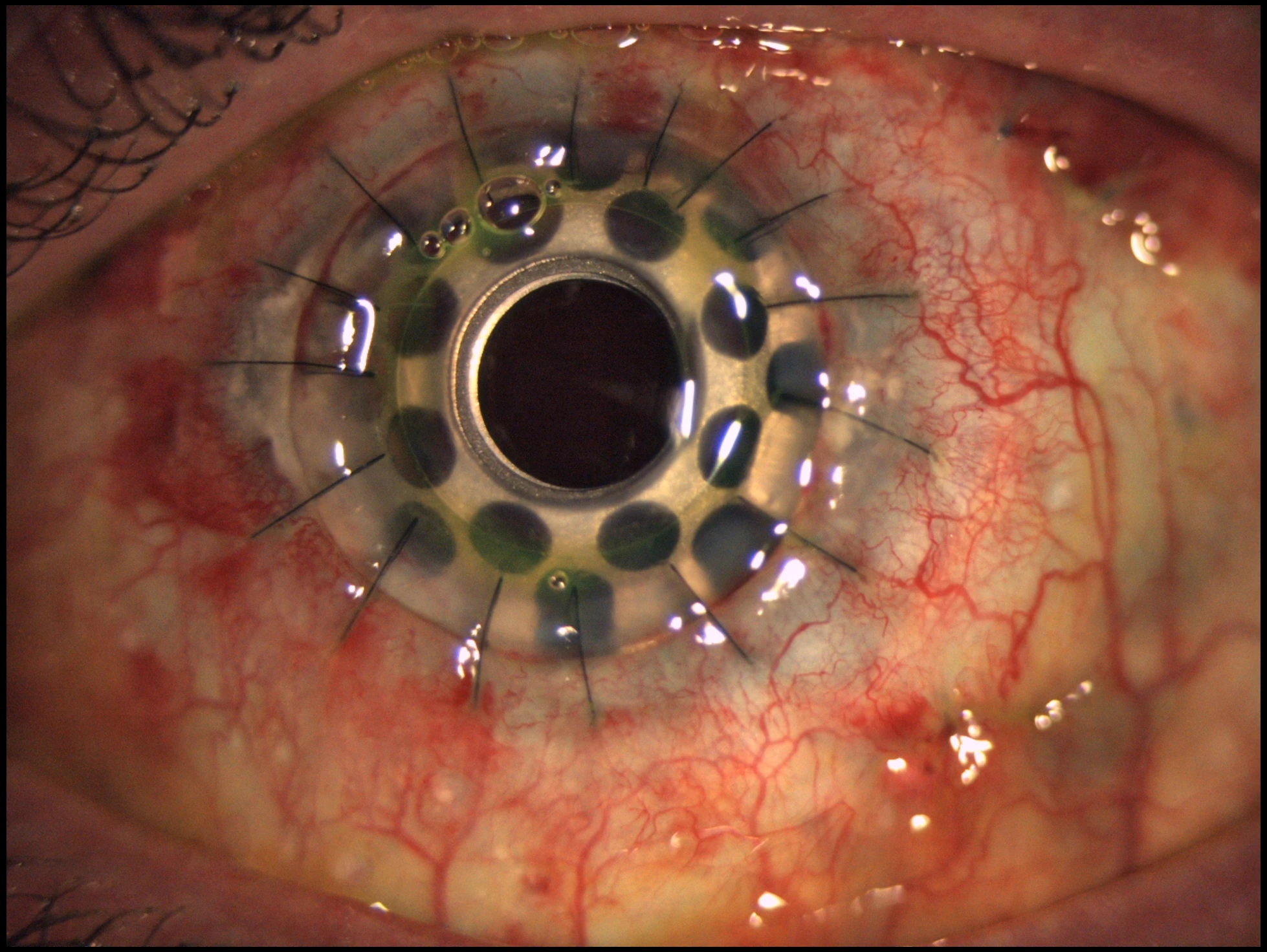 Boston KPro Type I frontal postoperative image