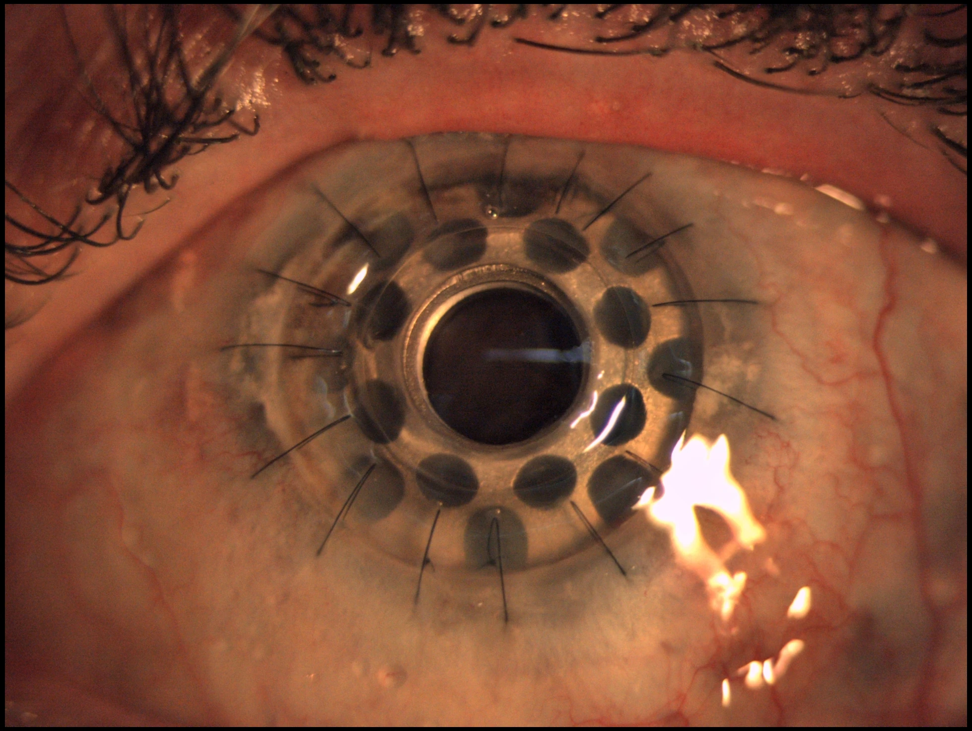 Boston KPro Type I with ocular surface detail