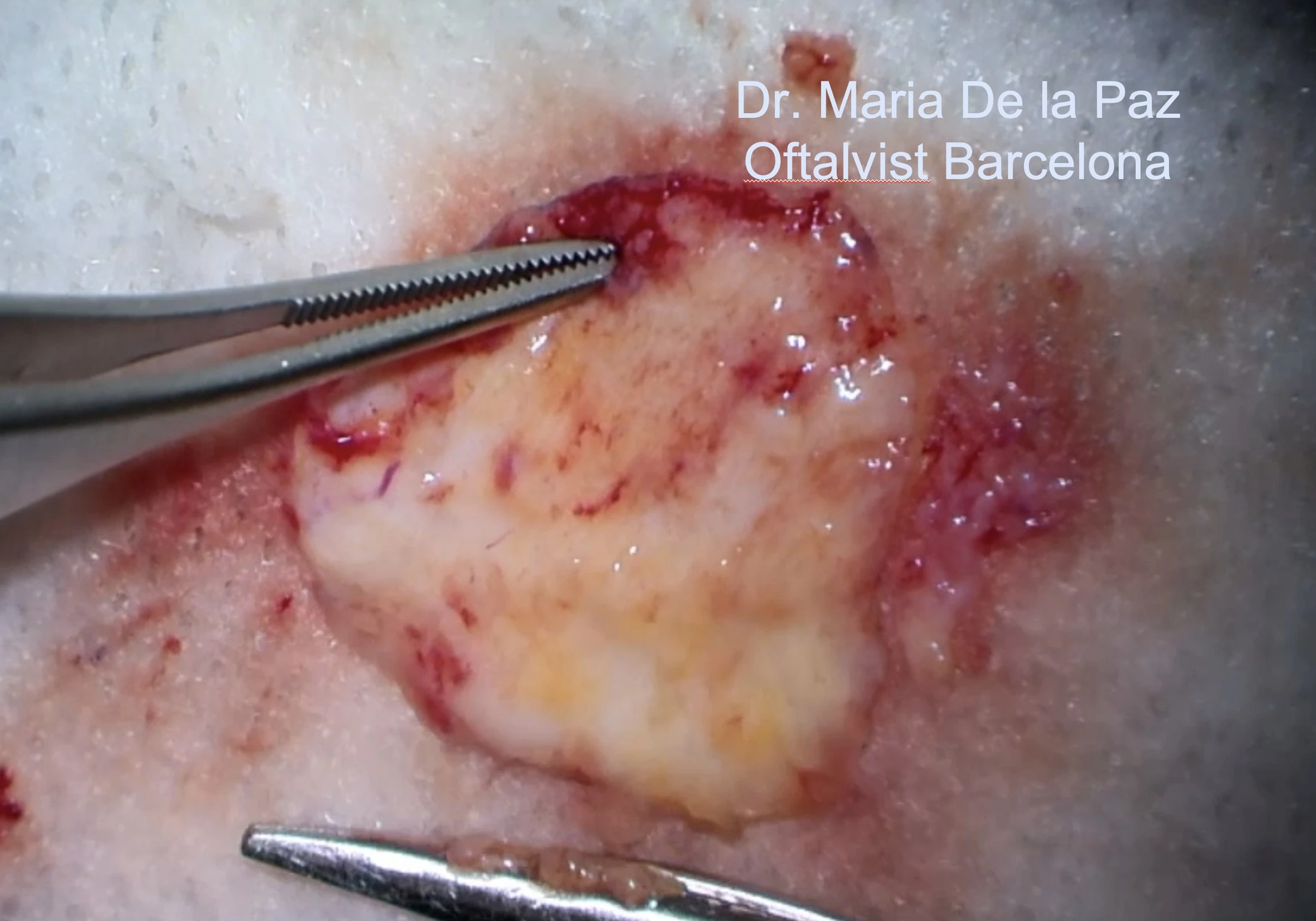 Buccal mucosa