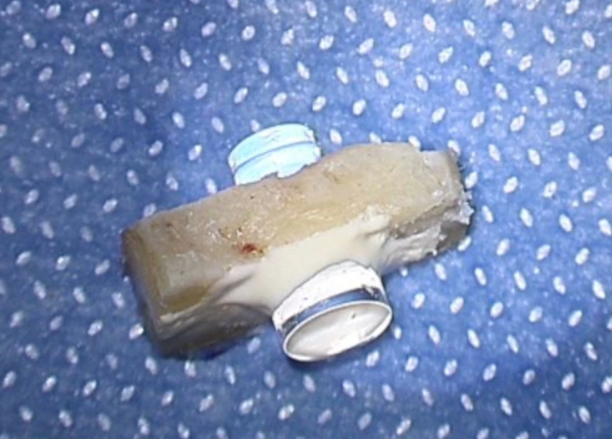OOKP · Osteo-odonto lamina with optic