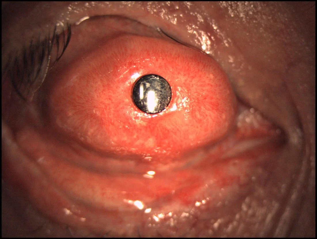 Osteo-Odonto-Keratoprosthesis