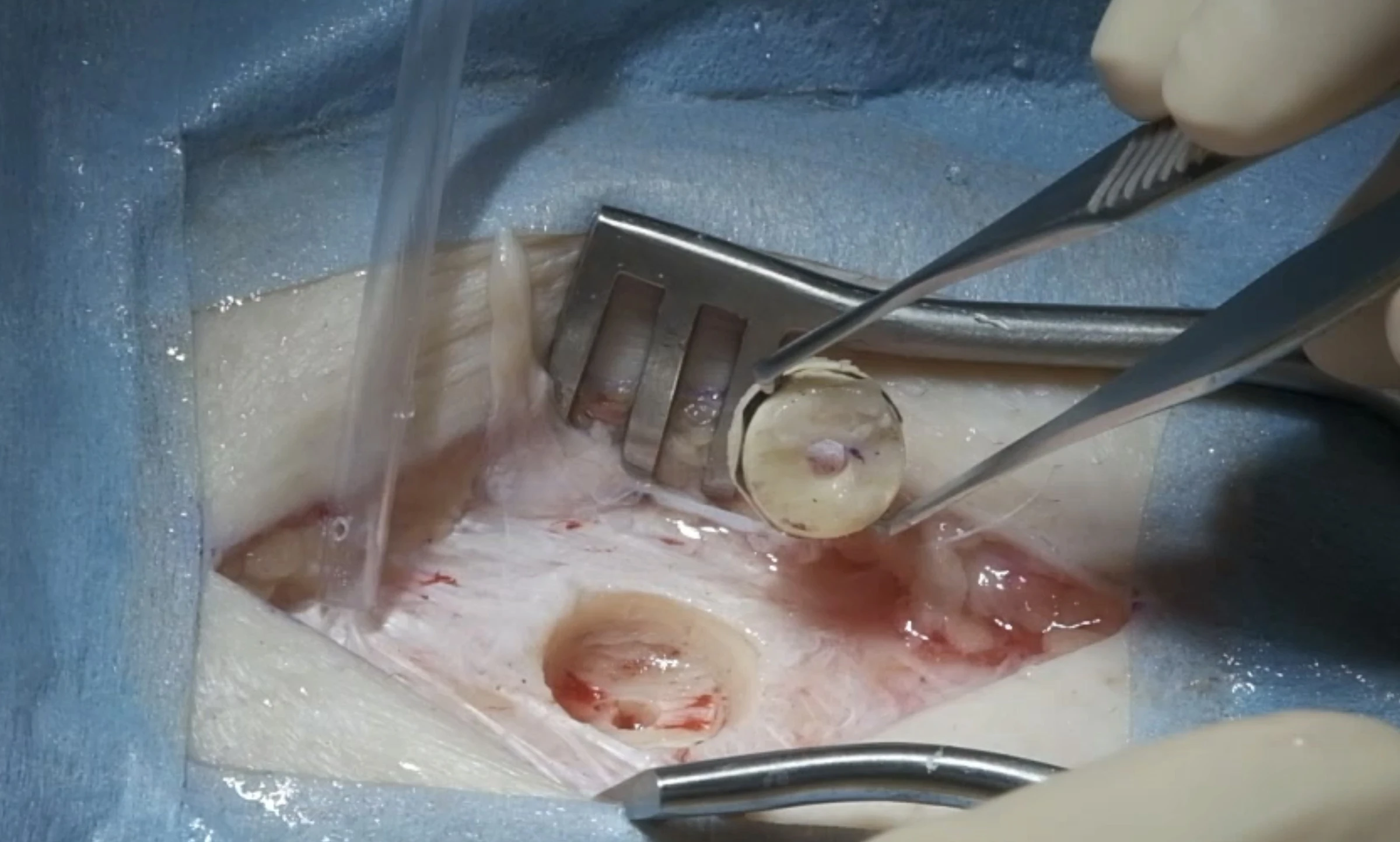 Tibial Bone Keratoprosthesis clinical photograph